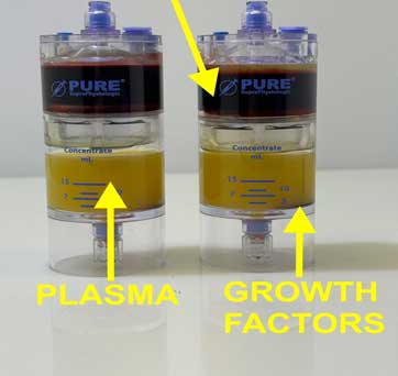 centrifugation_PRP_A2M